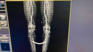 «إنجاز طبي جديد».. مستشفى الغردقة العام ينجح في إنقاذ مريض يعاني من «انسداد الشرايين»