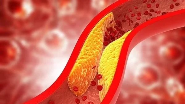 التعرق المفرط في فصل الصيف.. أسبابه وعلاجه