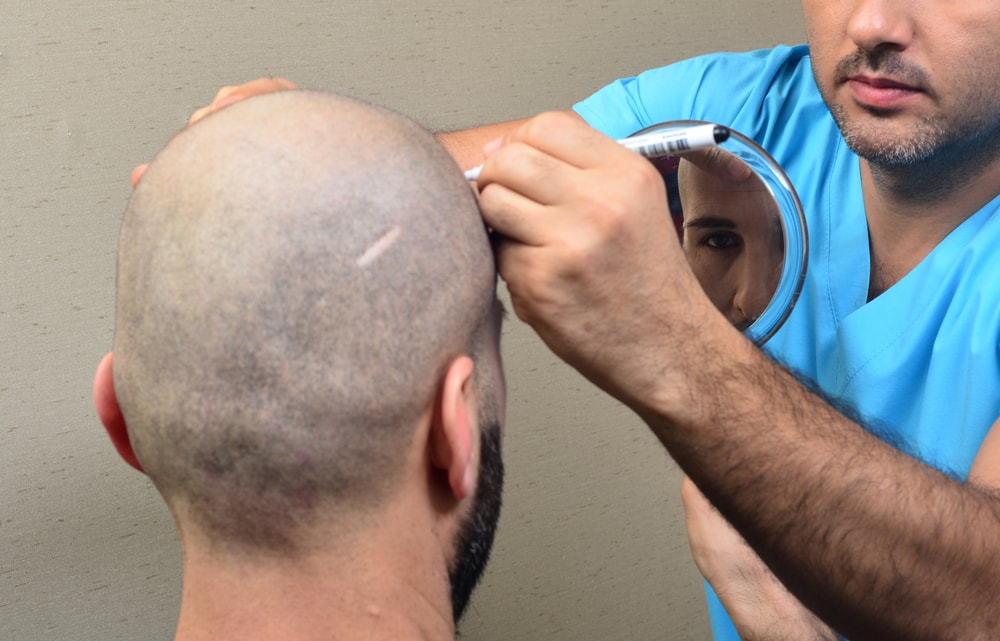 كيف أتوضأ بعد زراعة الشعر؟ عضو مركز الأزهر تجيب
